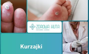 Kurzajki – jak wyglądają i jak skutecznie je usunąć?