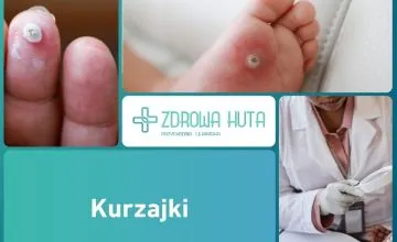 Kurzajki – jak wyglądają i jak skutecznie je usunąć?